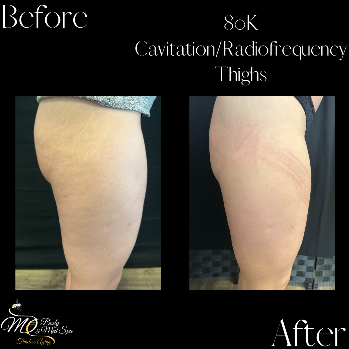80K Cavitation_Cellulite Reduction.png