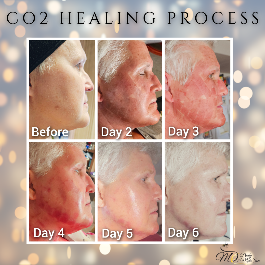 CO2 Laser Resurfacing: What’s the Cost for Under Eyes?