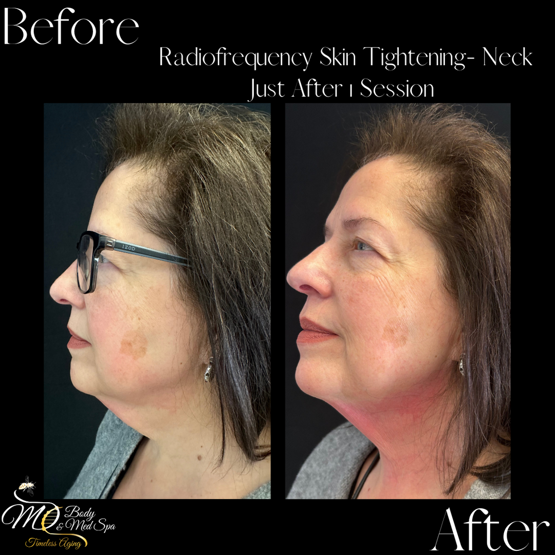 Chin Up! A Guide to Botox and Kybella for Double Chin Reduction