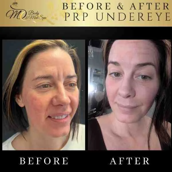 Shrink the Sacks: Effective Eye Bag Reduction