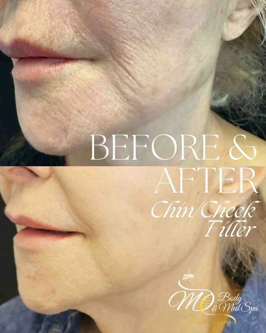 Sculpt and Transfer: A Guide to Body Contouring