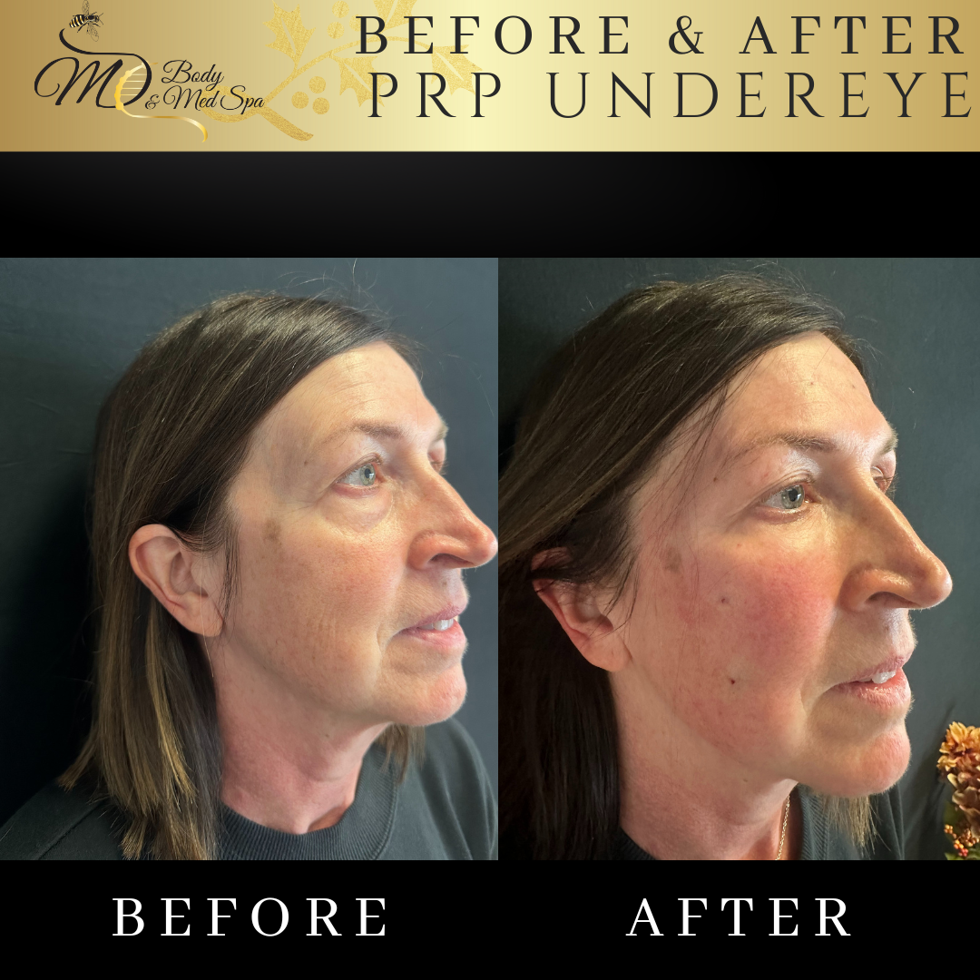 Eye-Opening Treatments: Best Cosmetic Options for Under Eyes