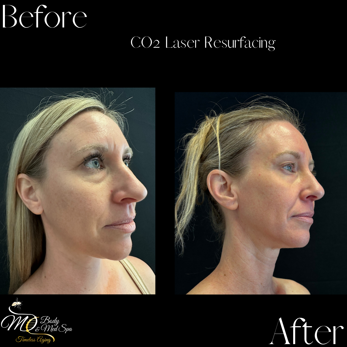 Side-by-side comparison of a woman before and after CO2 laser resurfacing treatment, showing facial skin improvements.