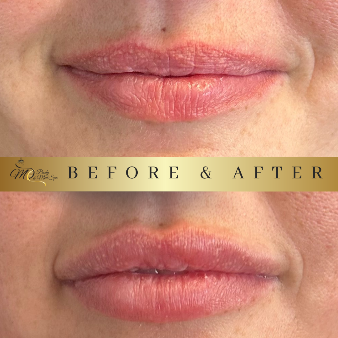 Lip Filler (5).png