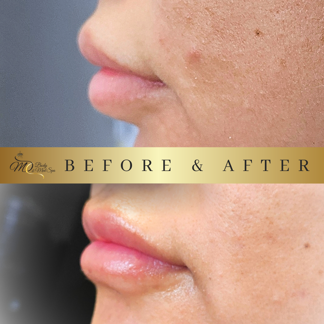 Lip Filler (6).png