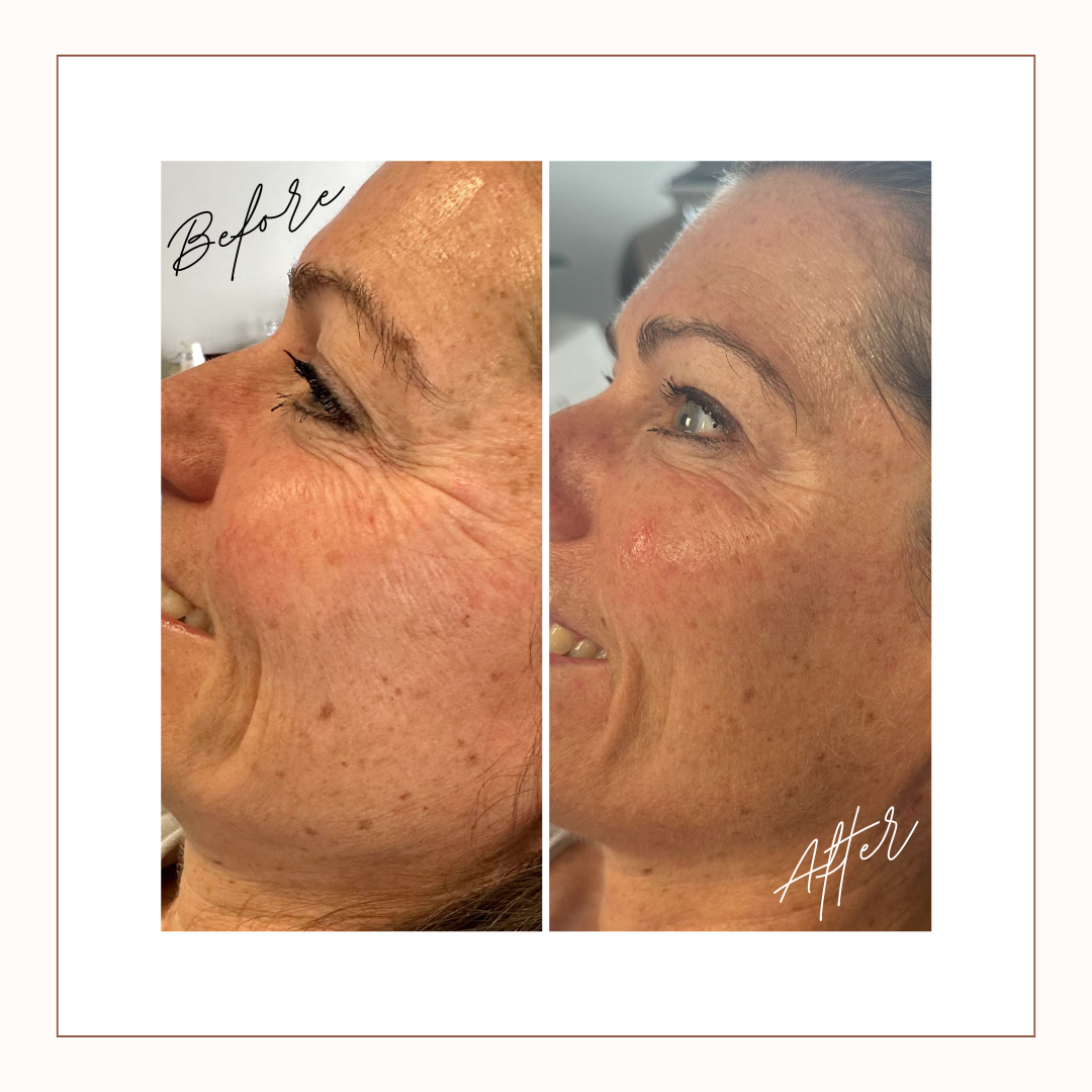 Side-by-side comparison of a woman's face showing skin improvements, with 'Before' on the left revealing wrinkles and pigmentation, and 'After' on the right showing smoother, clearer skin.