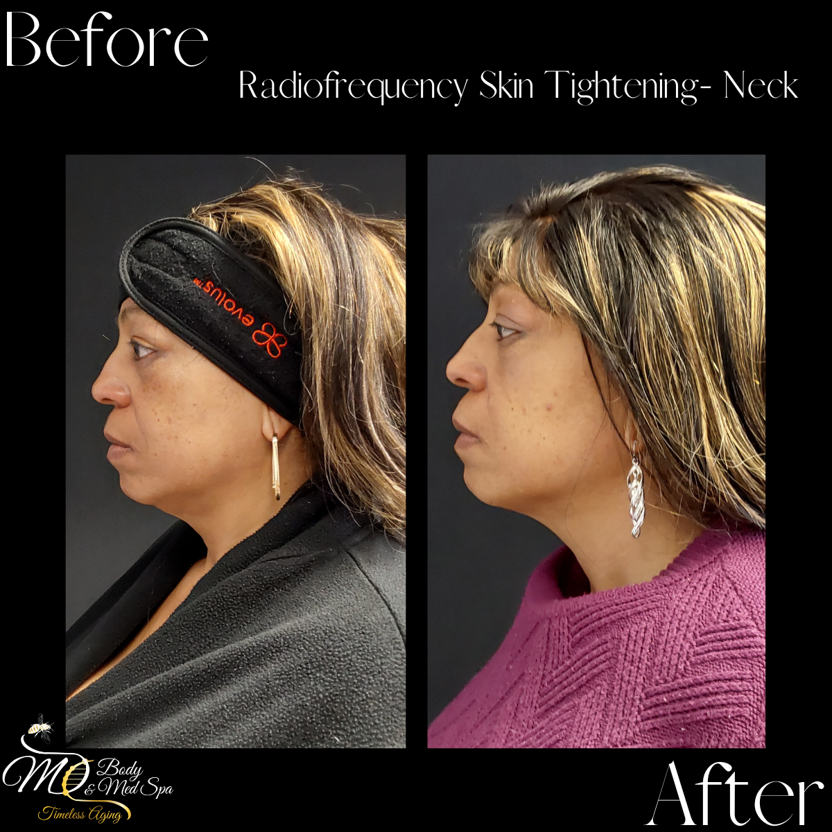 Side-by-side comparison photo showing before and after results of radiofrequency skin tightening for the neck, with the left image labeled 'Before' and the right labeled 'After.'
