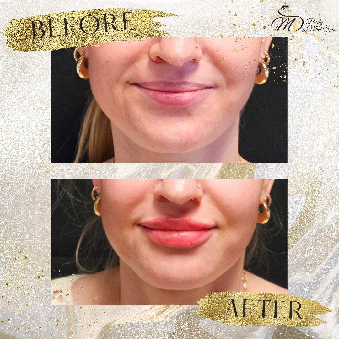Lip Filler.png