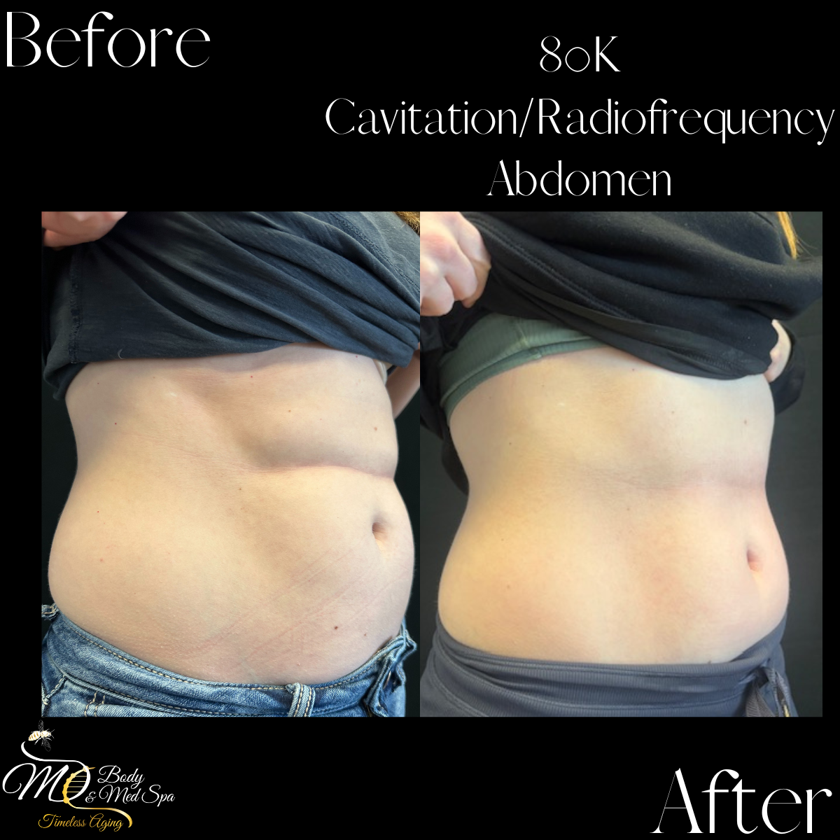 80K Cavitation Cellulite Reduction_Body Contouring.png