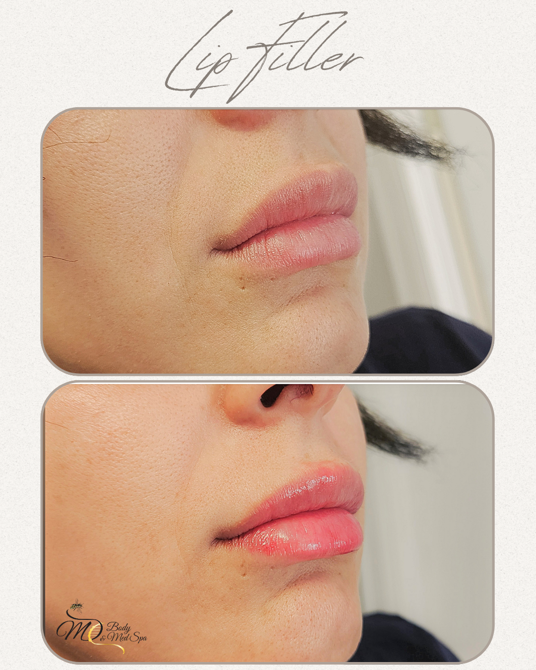 Lip Filler (7).png