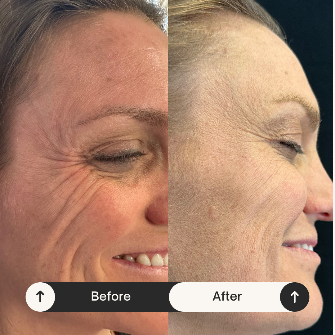Side-by-side comparison of a woman's face showing the before and after effects of a cosmetic procedure, with visible reduction in wrinkles and improved skin texture.