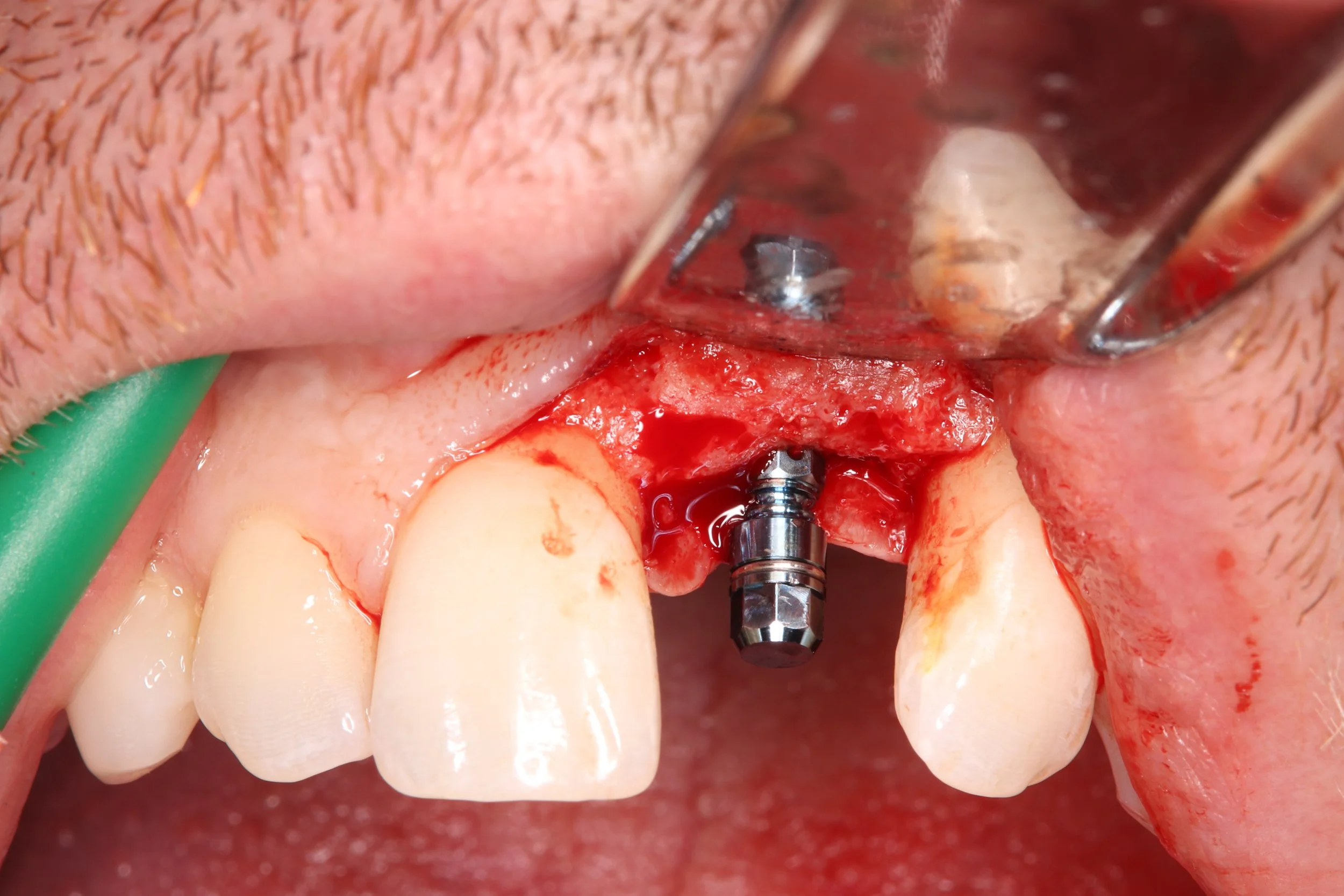 Implant placement 3 months later