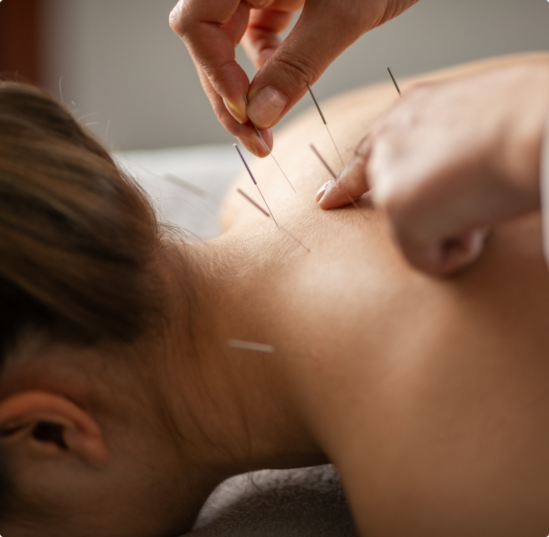 Dry Needling Therapy