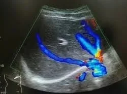 Abdomen Doppler in Dade City, Florida