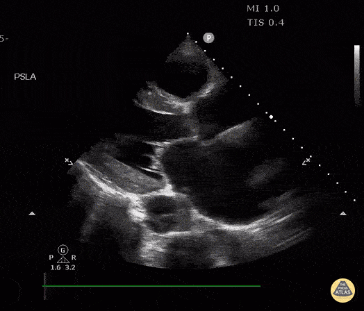 Descending Thoracic Aortic Dissection