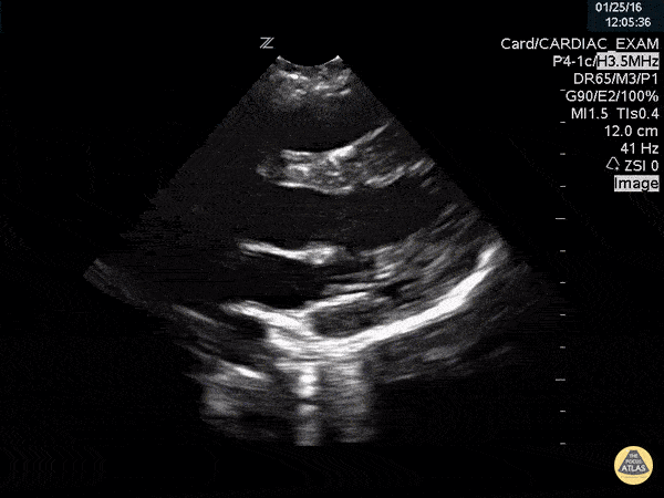 Aortic Dissection Flap Visualized in Proximal Aorta with Root Dilation