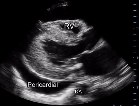 pericardial vs pleural 1.gif