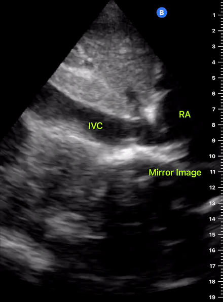 Normal IVC Label.gif