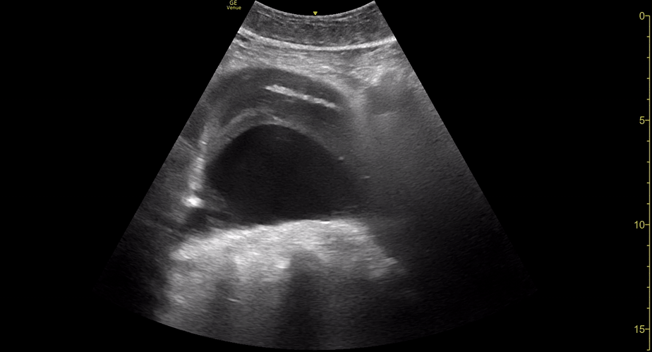 US_AAA+Haematoma - Long.gif