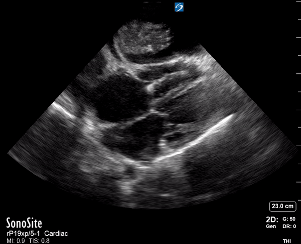 SX Pleural effusion.gif
