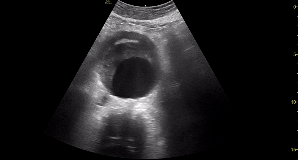 US_AAA+Haematoma - Trans 1.gif