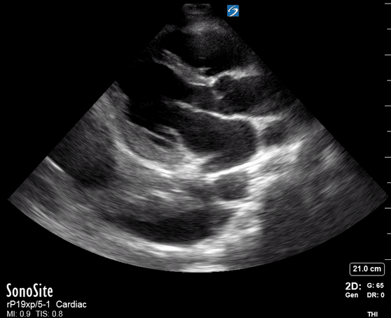 PLAX pleural effusion.gif