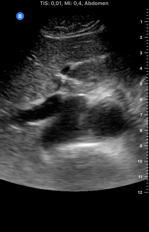 Normal+aorta+&+IVC+-+Transverse.gif