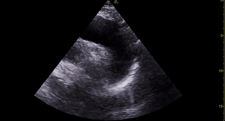 Aneurysmatic arch.gif