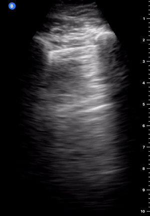 Rt Lung Mid Clav.gif