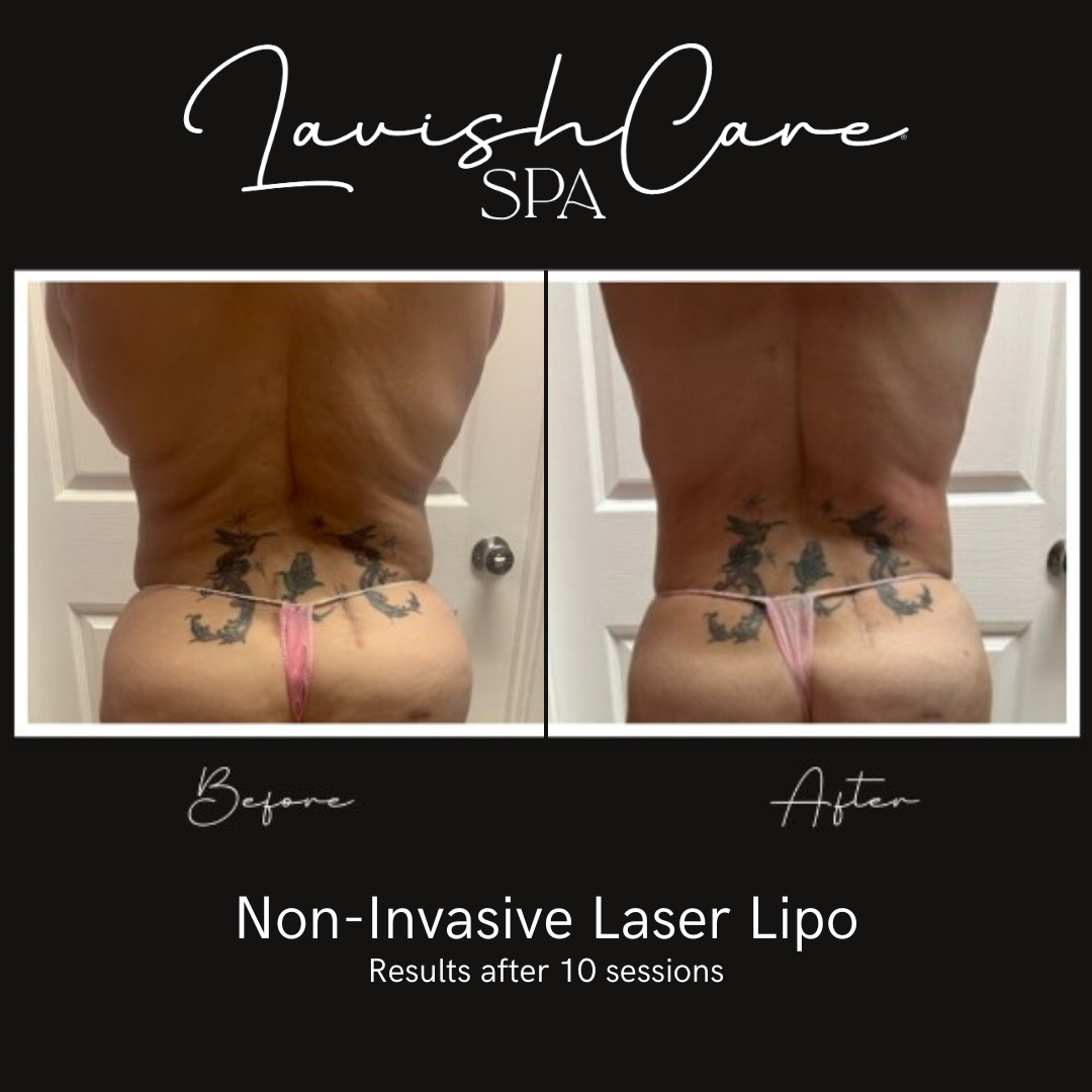 LaserLipo10Sess.png