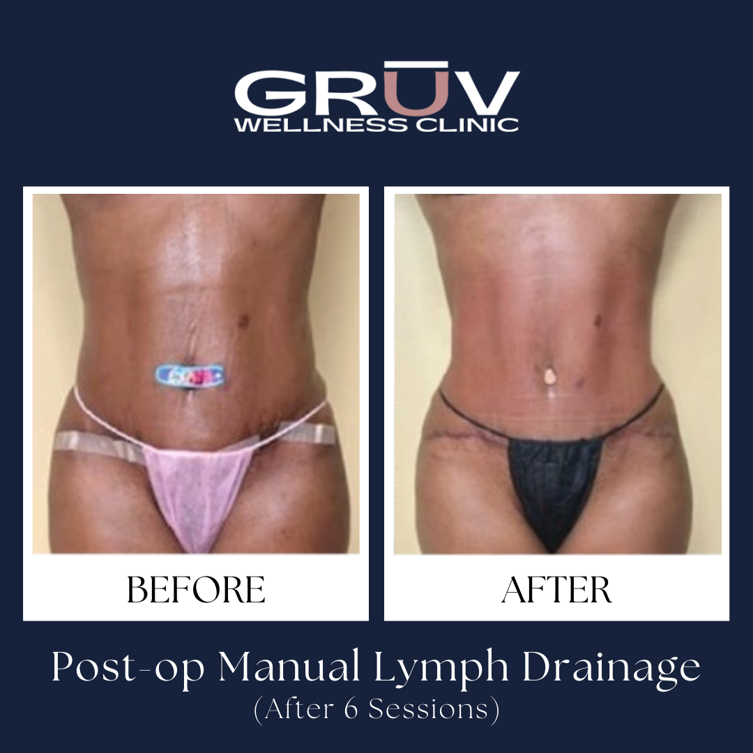 Click to view: LYMPHATIC DRAINAGE RESULTS
