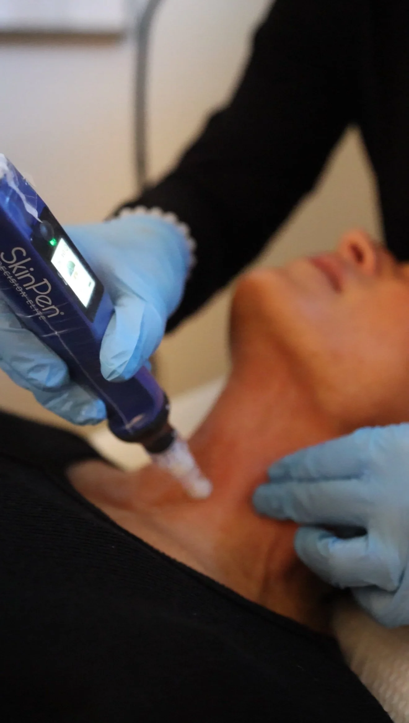 SkinPen treatment Genesis by Janelle