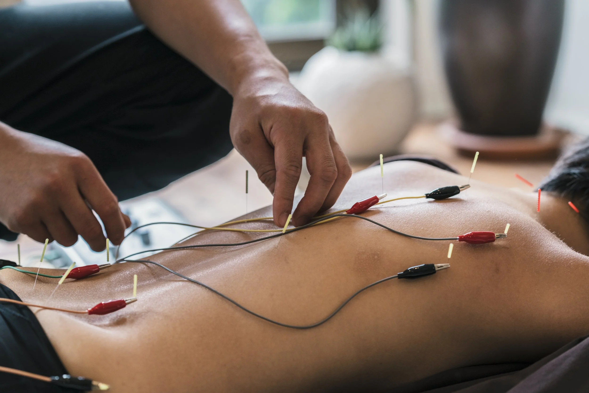 Why Dry Needling is a Must-Have Tool for Active Recovery