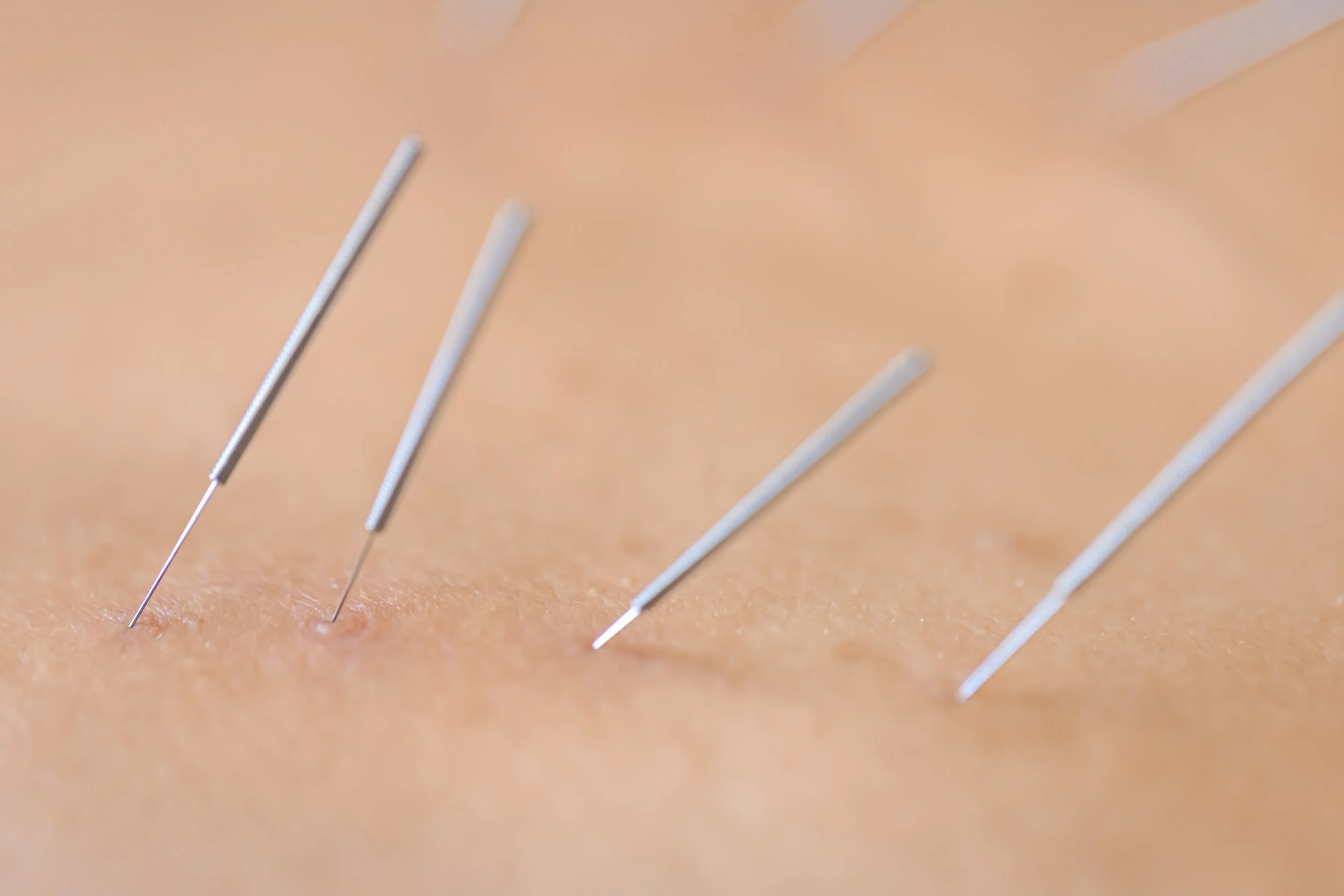 Debunking the Top 5 Myths About Dry Needling
