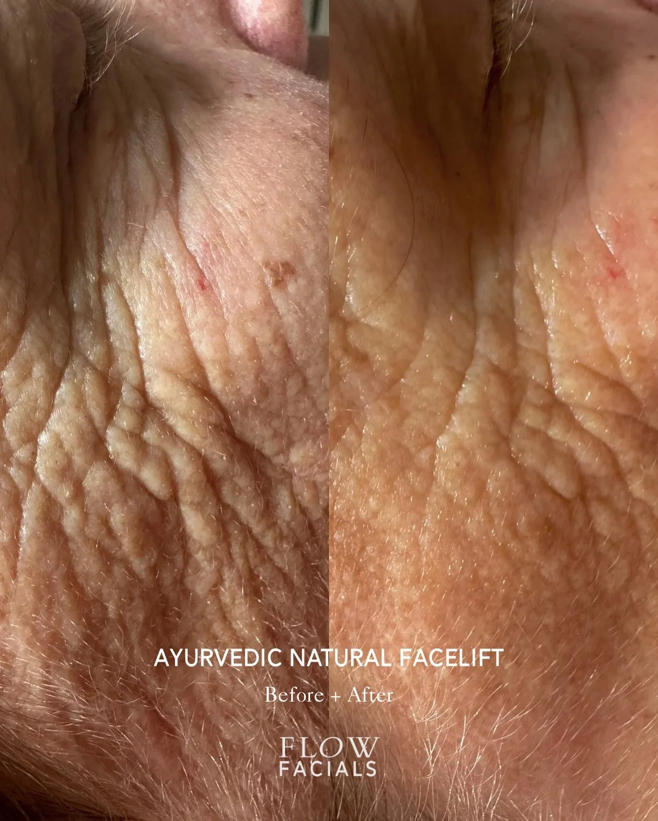 Ayurvedic Natural Facelift.

Exclusive to @flowfacials. Ageing well. Resting deeply. 

Anti-ageing, firming facial massage treatment that delivers a naturally youthful, energised skin without injectables.

If you are wanting a treatment to sculpt, fi