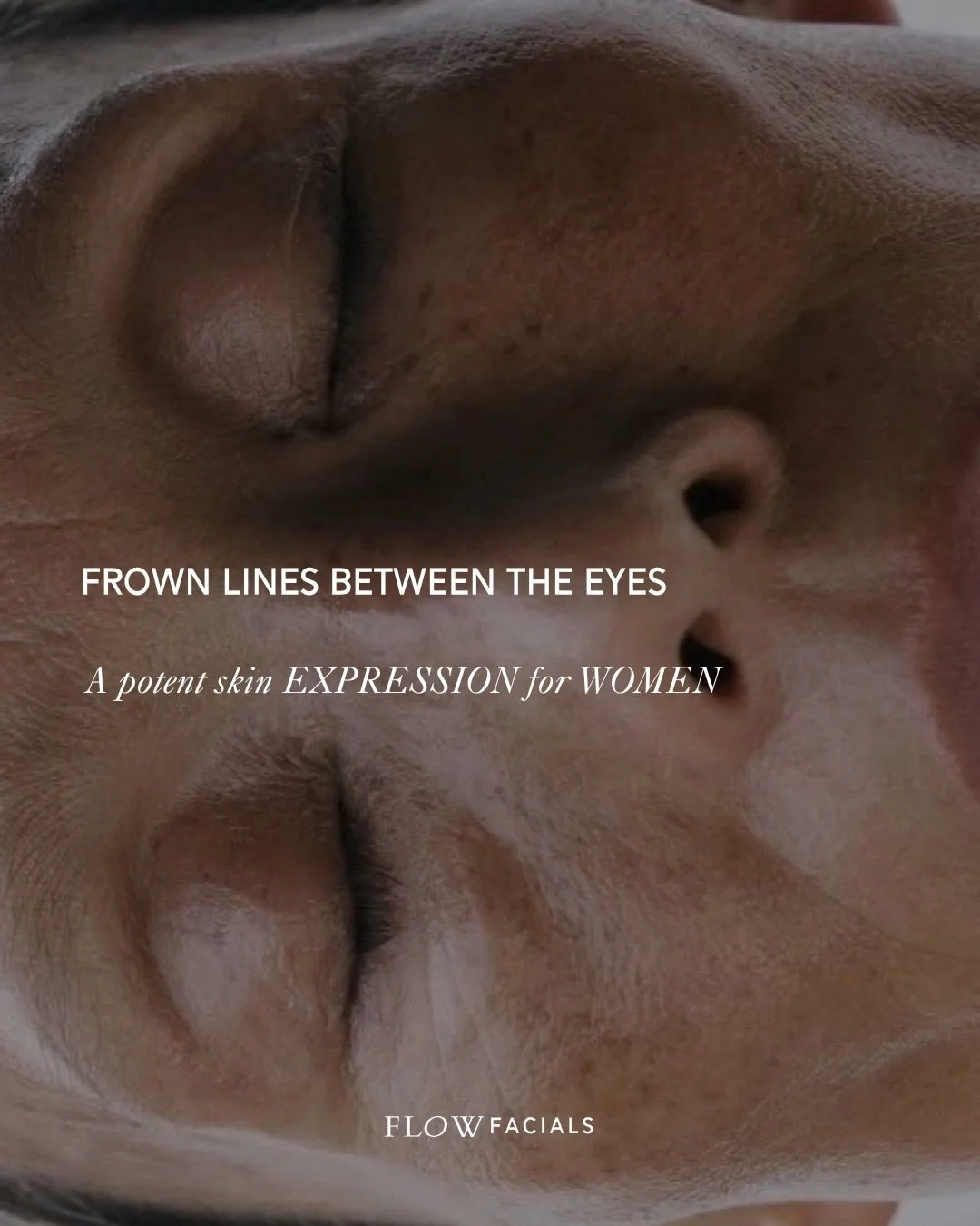 Frown lines between the eyes.

A potent skin expression for women. 
From an Ayurvedic beauty perspective, frown lines between the eyes can be synonymous with long term worry, overthinking, frustration and anger.

Vata (dryness, worry) + pitta (fiery 