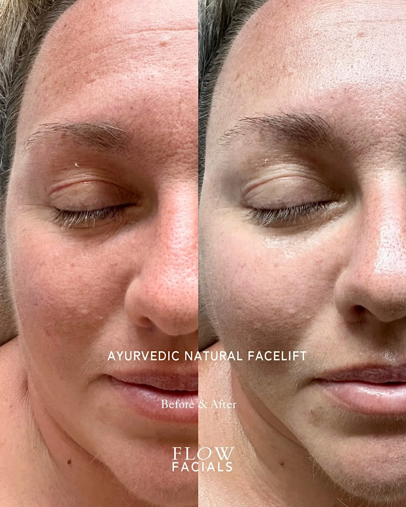 Ayurvedic Natural Facelift.

The restorative ritual for rejuvenation, inflammation &amp; TMJ tension. 

Our signature ritual that uses single ingredient profiles; rose water, jojoba &amp; castor oil with marma point + kansa wand massage.

This is aft