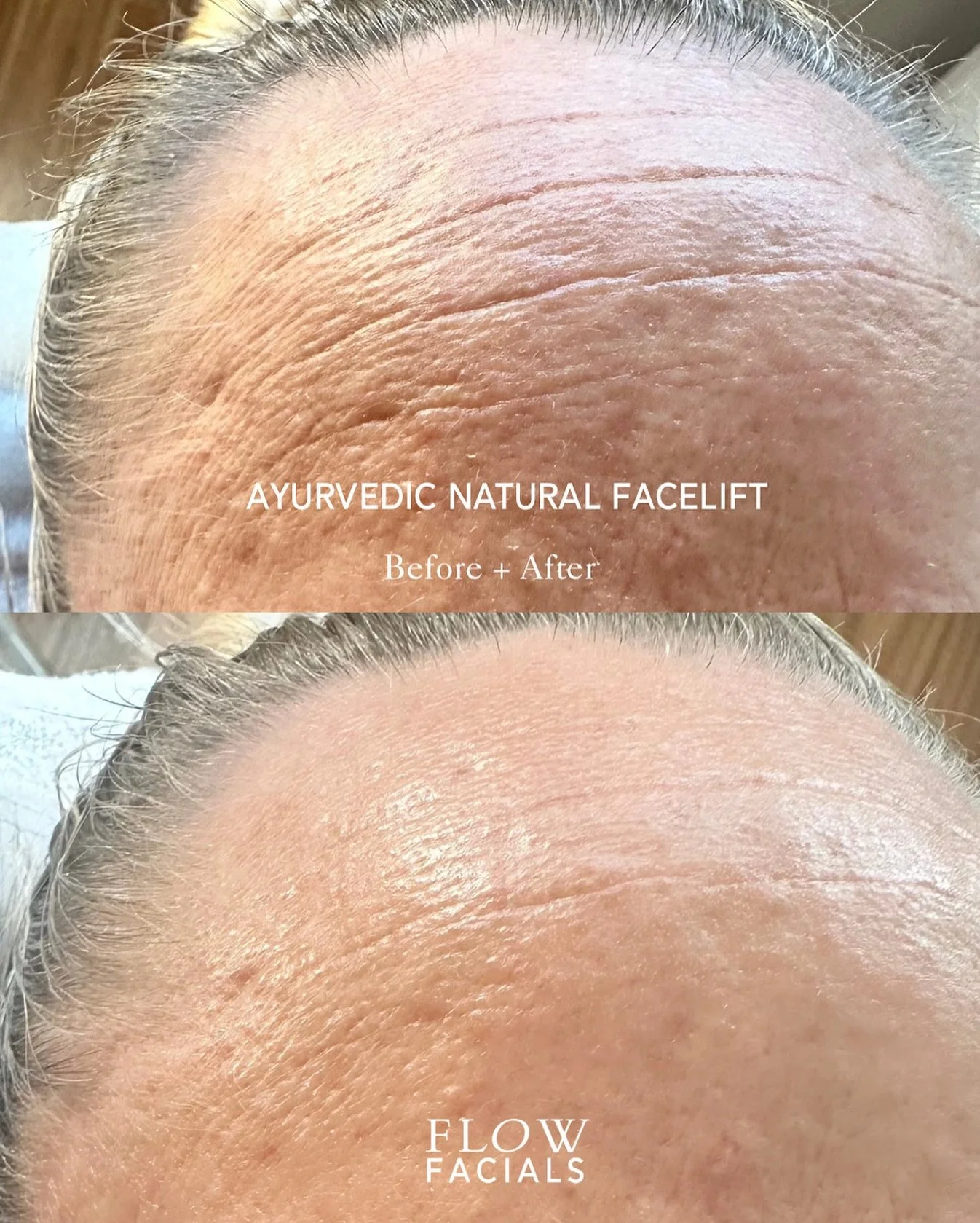 Ayurvedic Natural Facelift Ritual. Ageing radiantly with ancient wisdoms.

Anti-ageing, firming facial massage treatment that delivers a naturally youthful, energised skin without injectables.

If you are wanting a treatment to sculpt, firm and detox