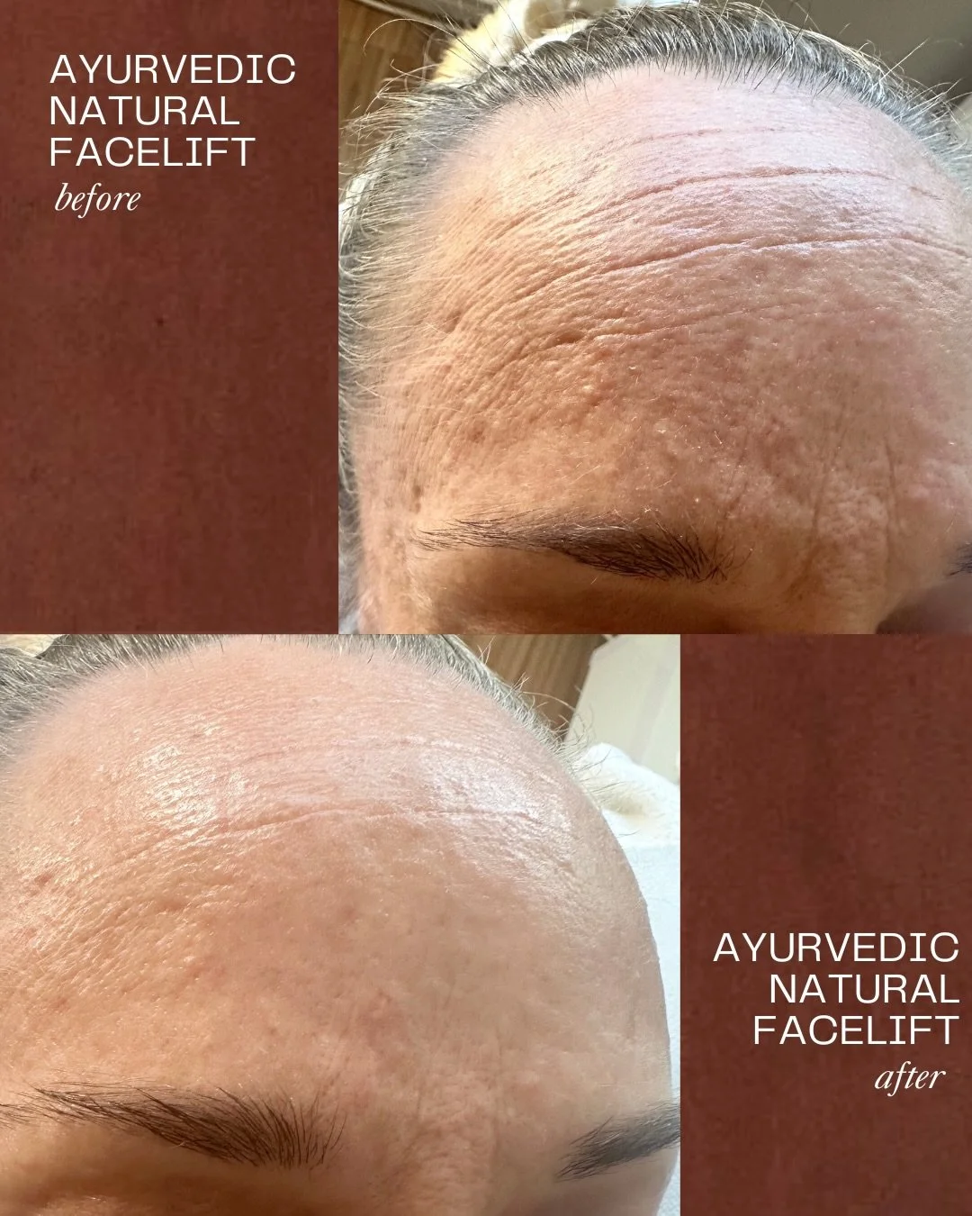 A client journey with the AYURVEDIC NATURAL FACELIFT ritual.

This was after 1 treatment. The best way to experience the restoration benefits is to do 3 x weekly or 6 x weekly/fortnightly.

This is a gentle ritual. We work specifically with your faci