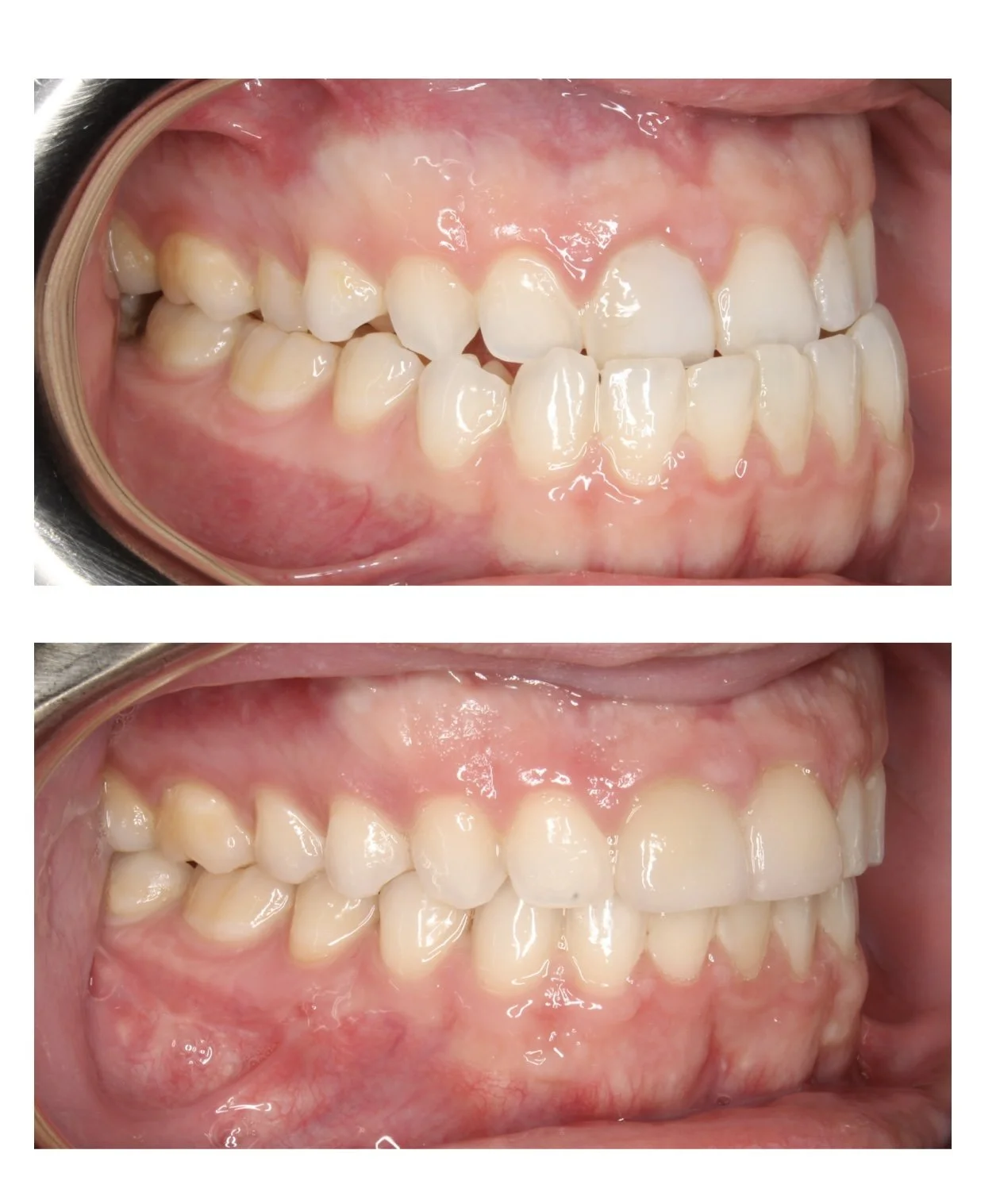 jaw-surgery-with-invisalign.jpg