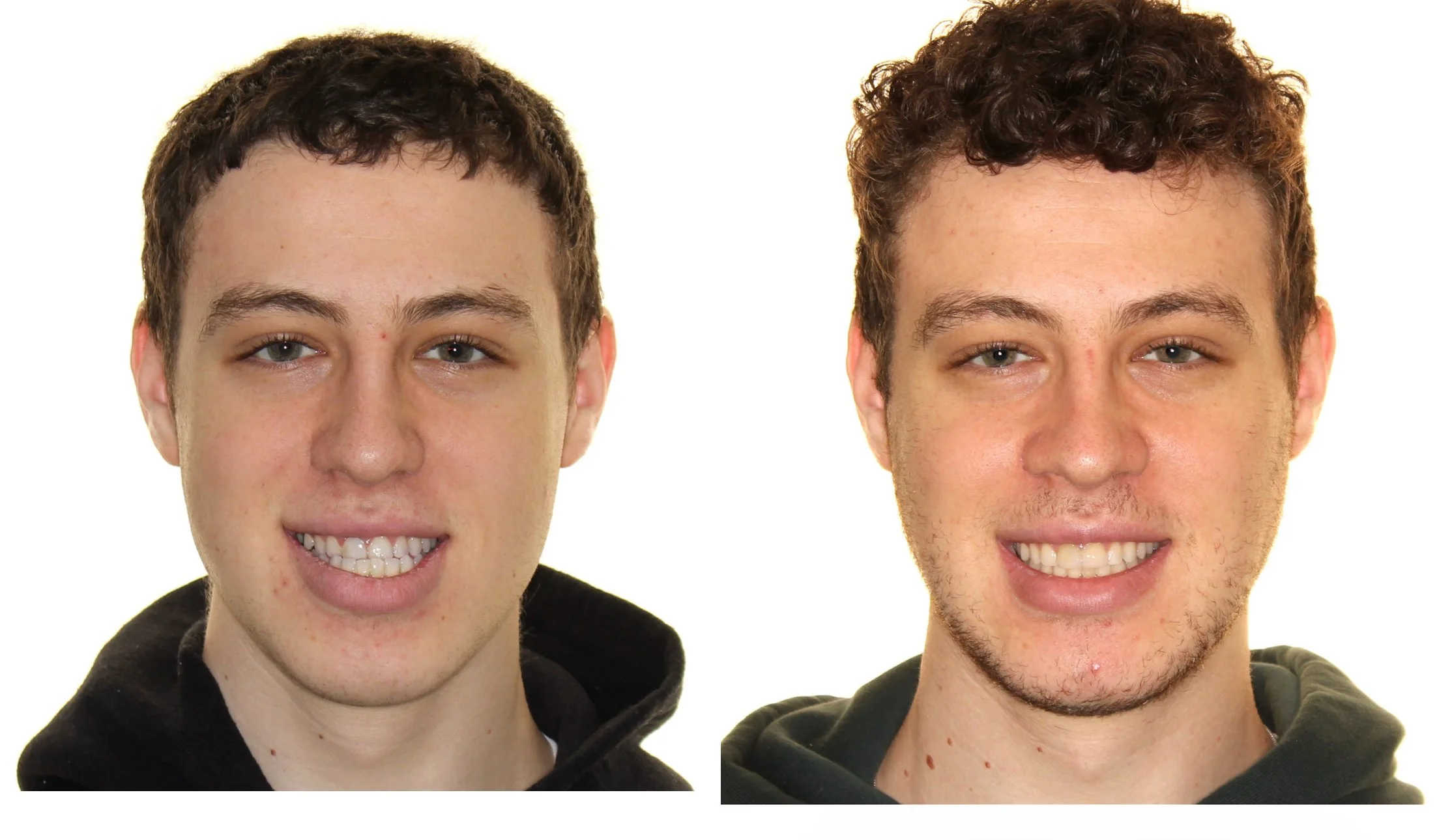 Orthognathic surgery triple jaw