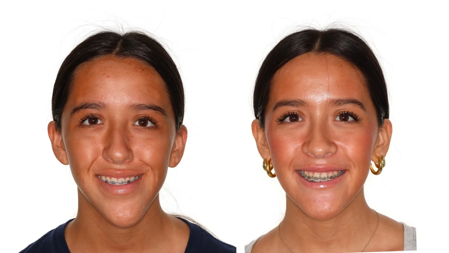 before-and-after-jaw-surgery.jpg
