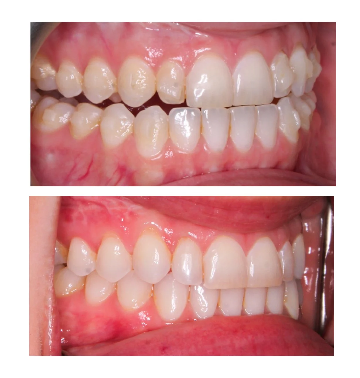 underbite-before-and-after.jpg