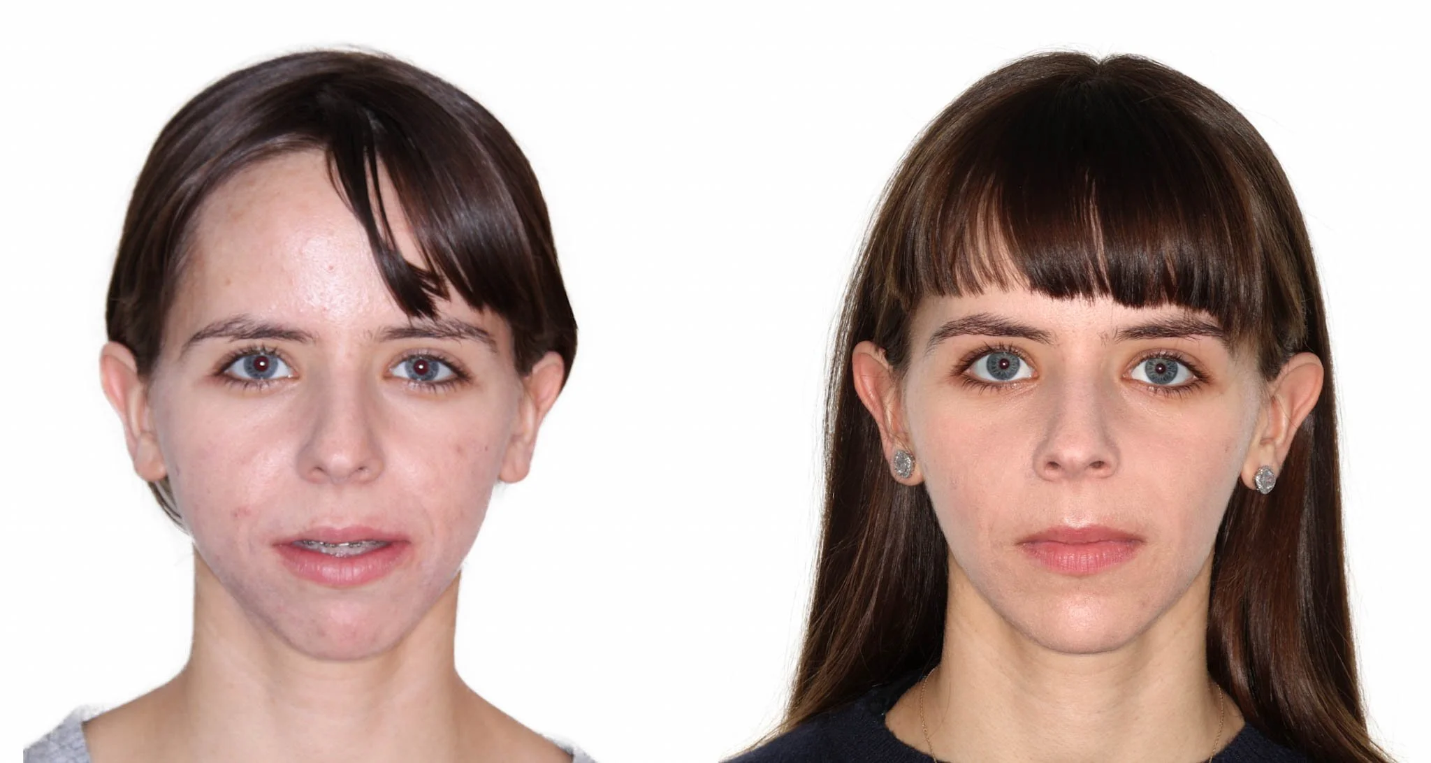 jaw-surgery-before-and-after.jpg