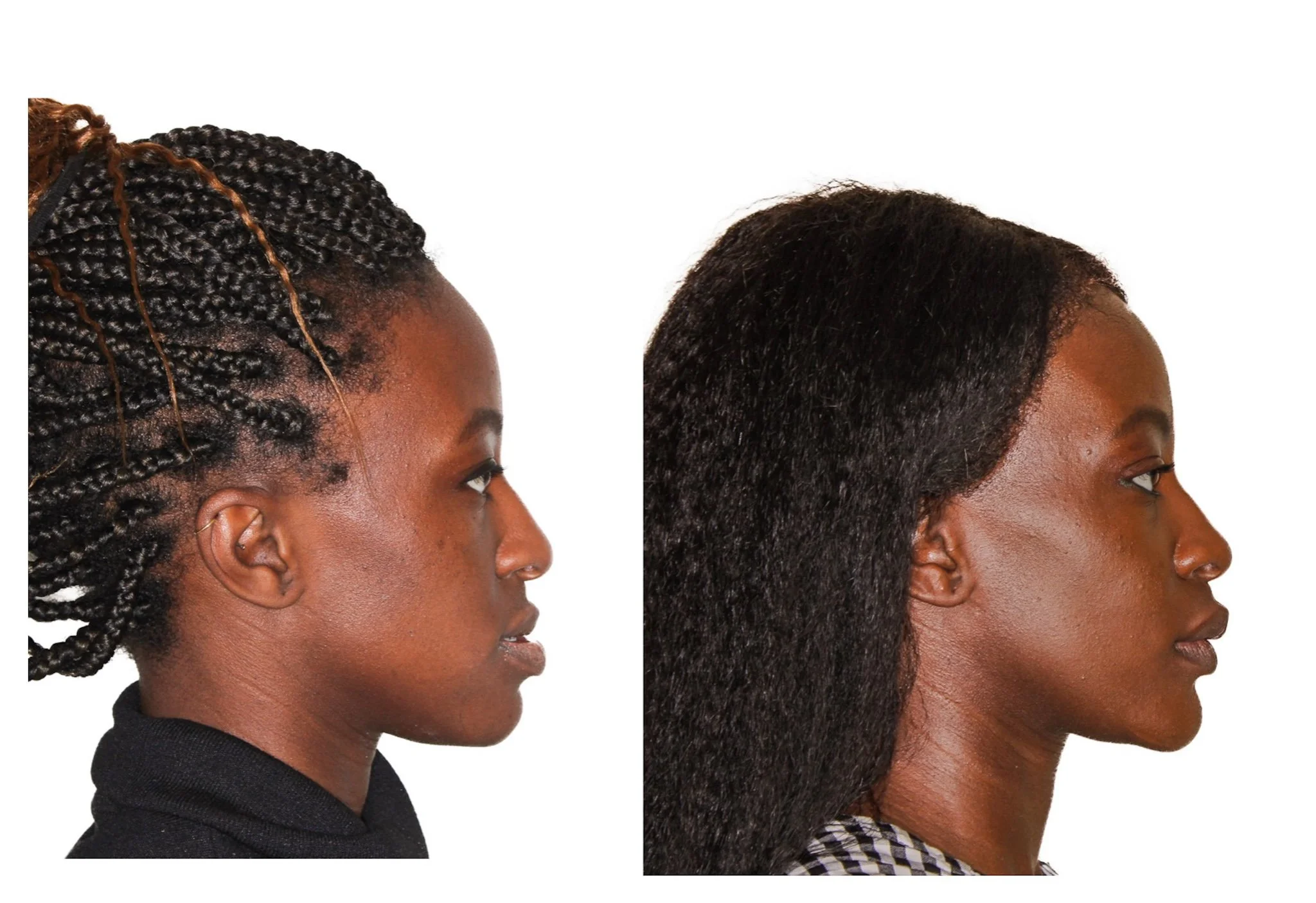 jaw surgery before and after