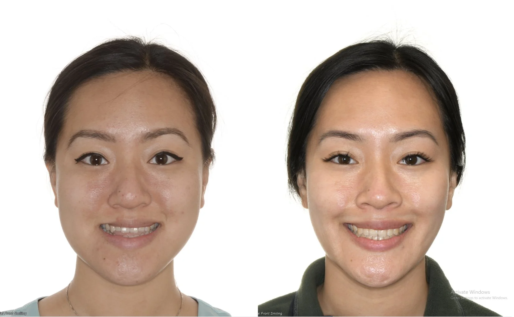 before-and-after-orthognathic-surgery.jpg