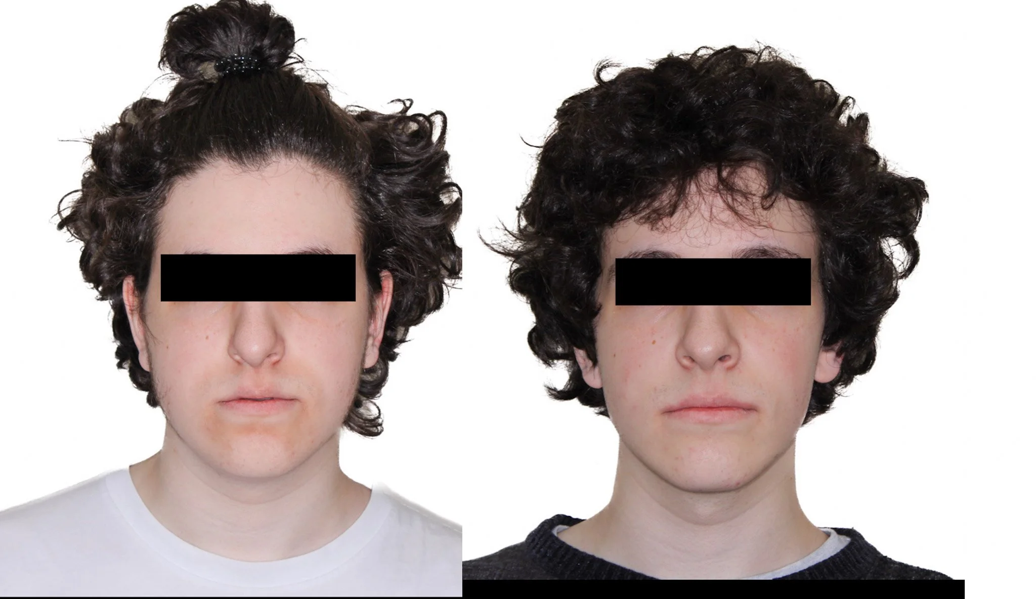 jaw-surgery-results.jpg