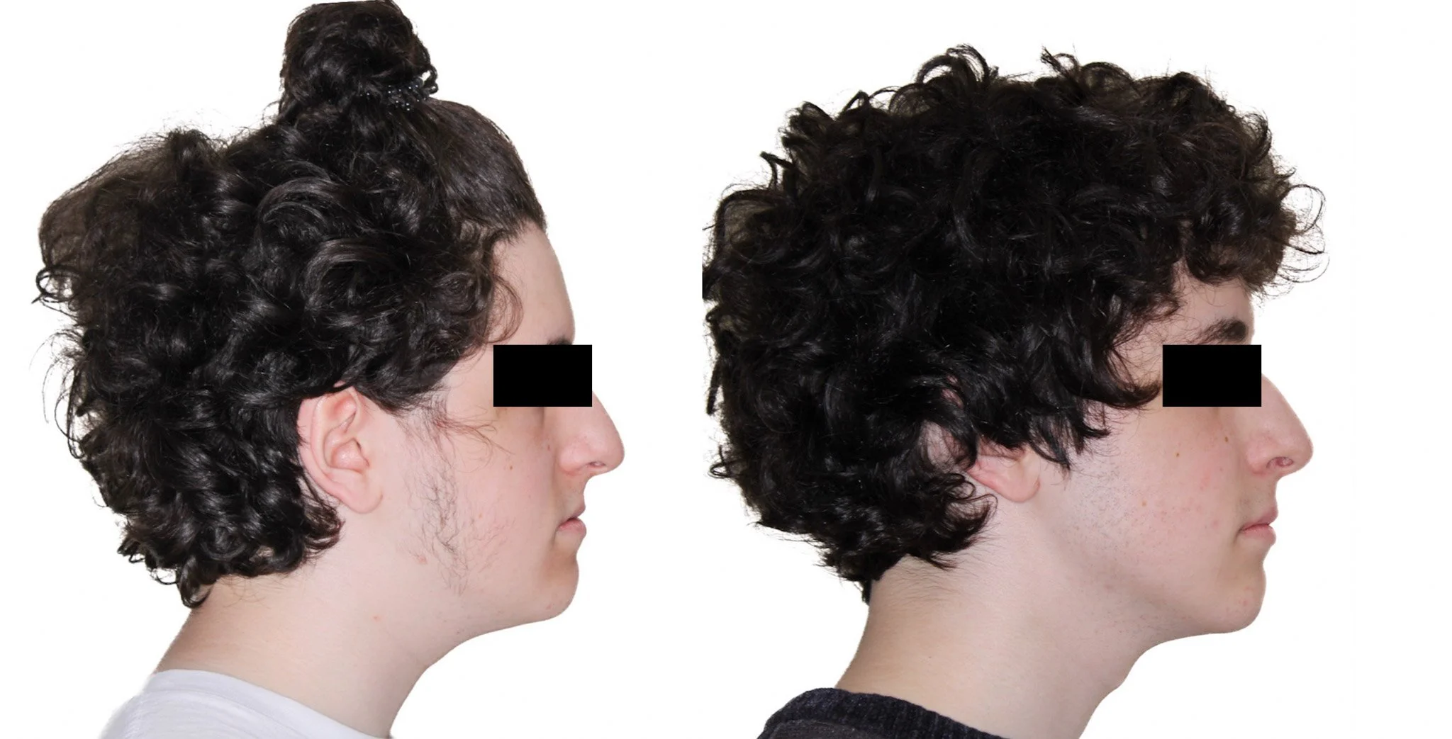 Lefort I maxillary advancement