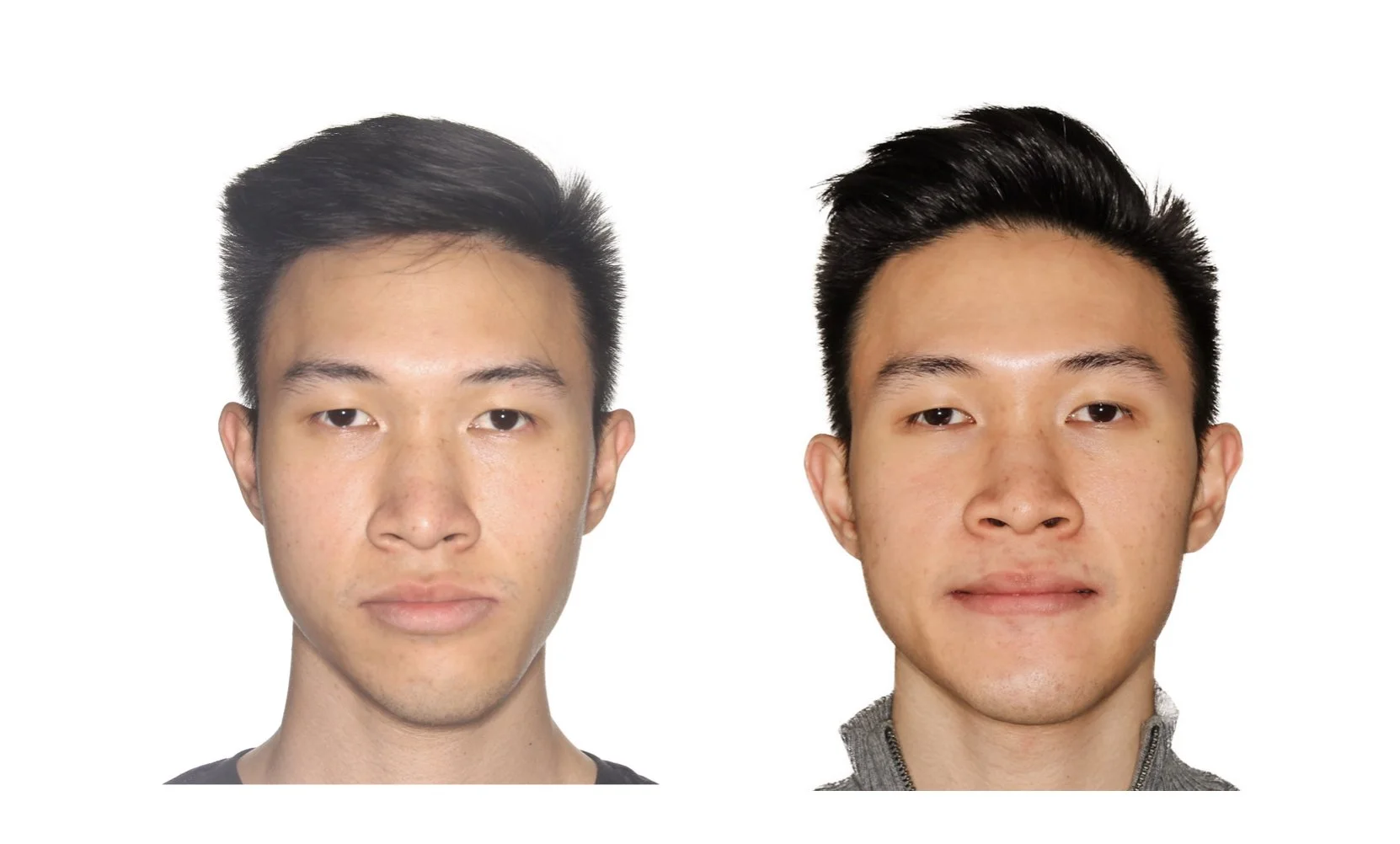 Class III/asymmetry — Elite Oral and Facial Surgery Long Island Oral