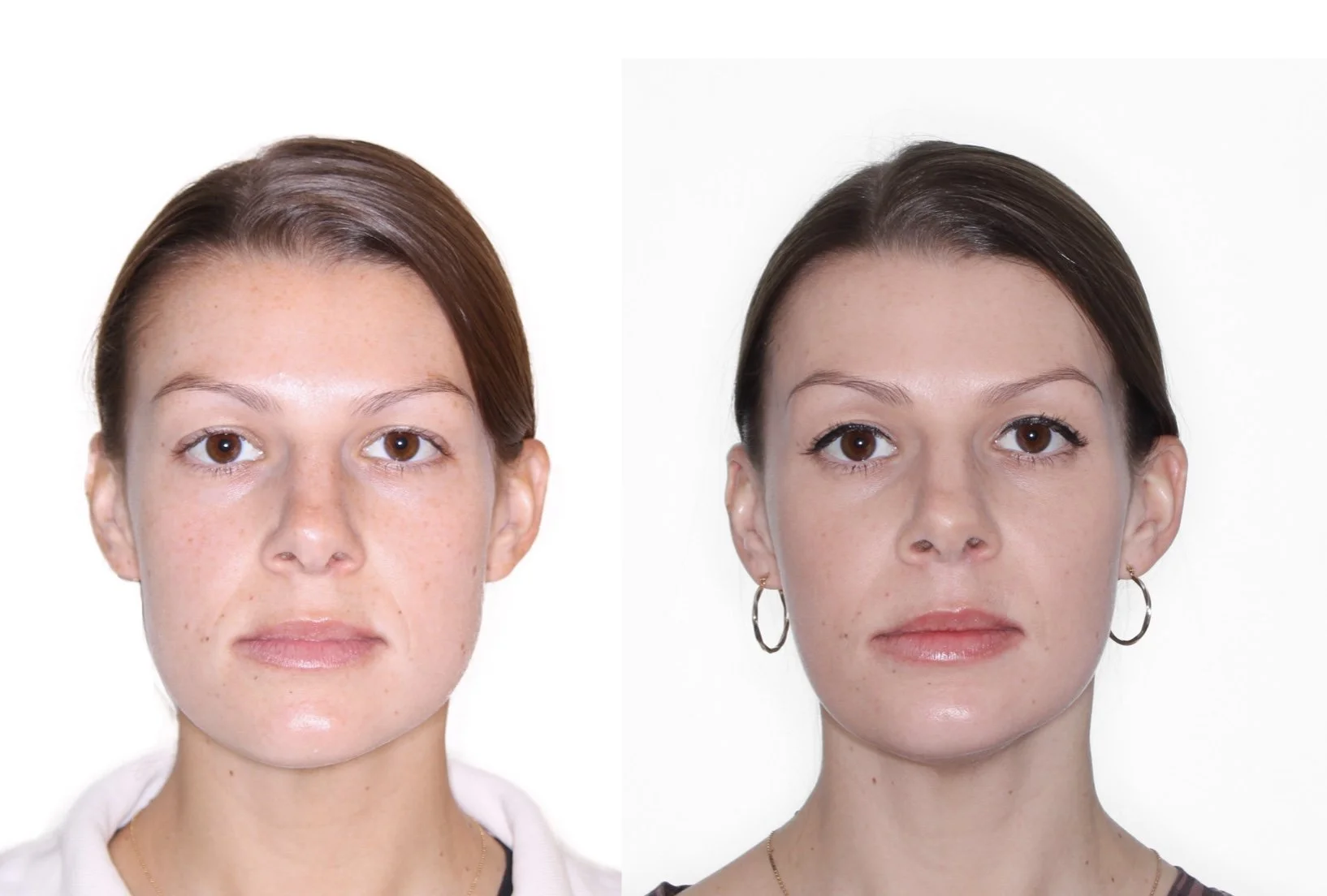 orthognathic-surgery-before-and-after.jpg